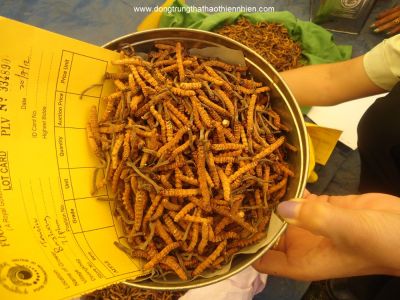 Sưng chân tái phát do huyết khối tĩnh mạch sâu